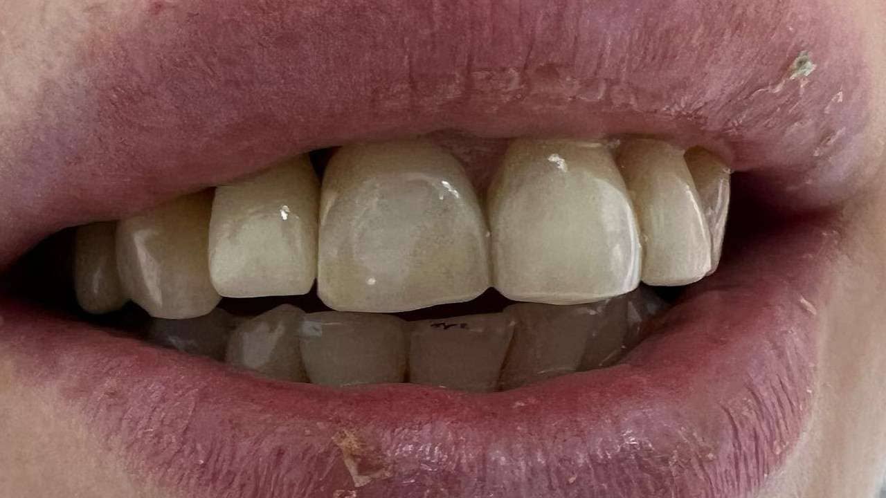 Одномоментная имплантация