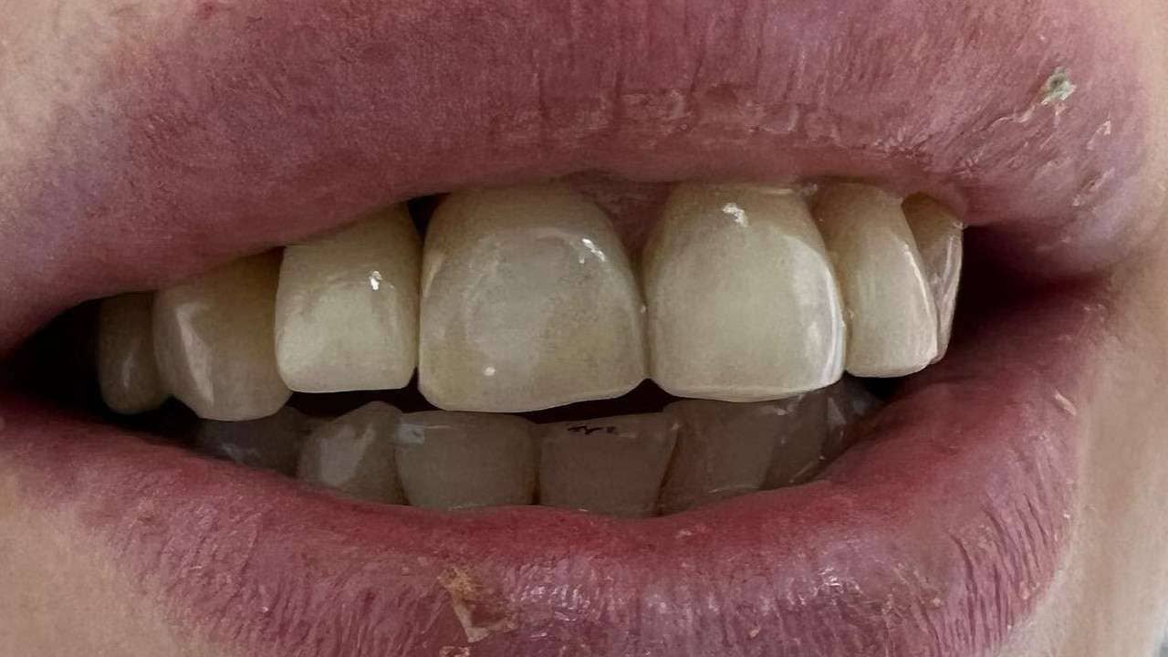Одномоментная имплантация